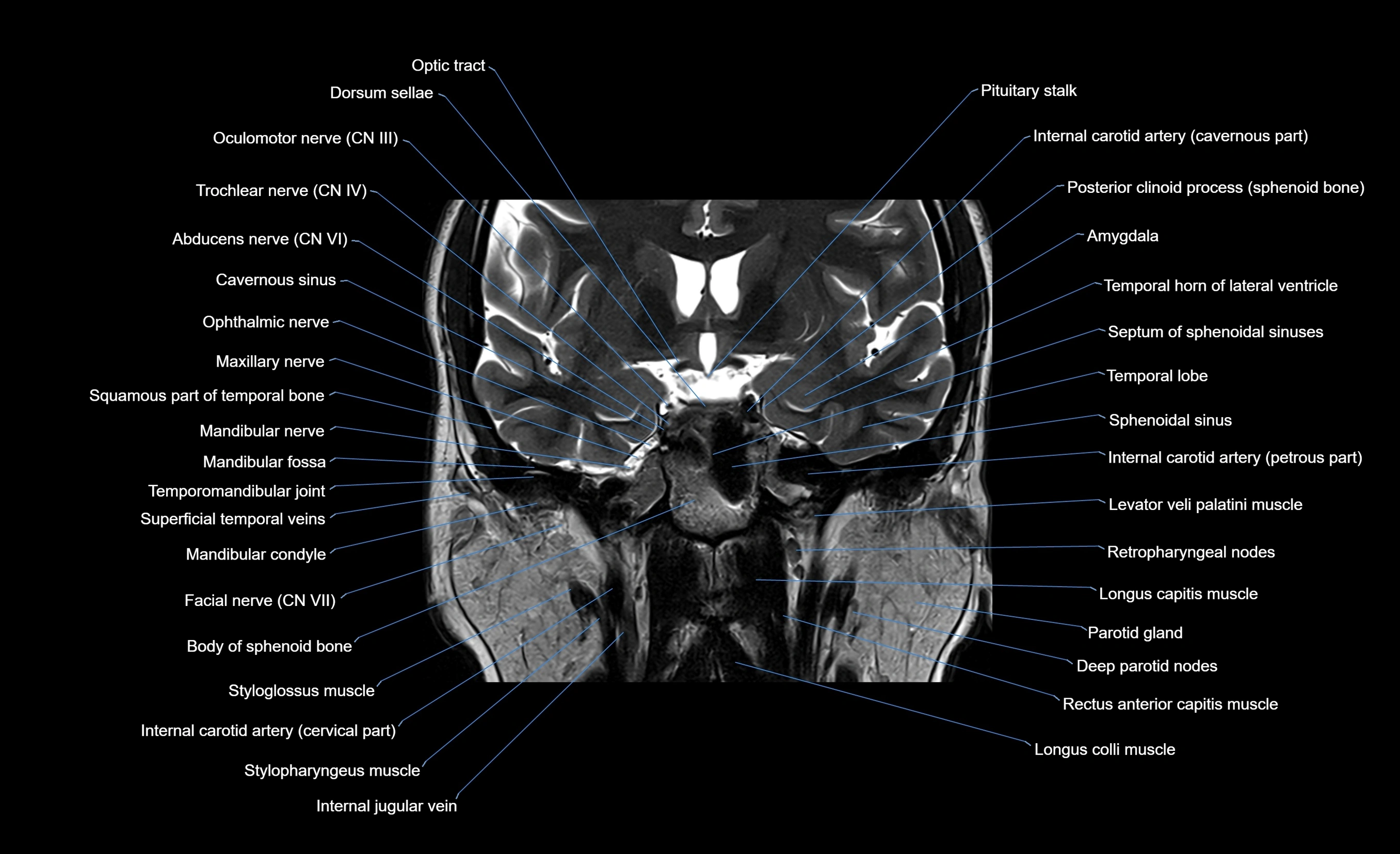 MRI face & paranasal sinuses(PNS) labelled  coronal  cross sectional anatomy 3T radiology  image-img-00001-00038.webp